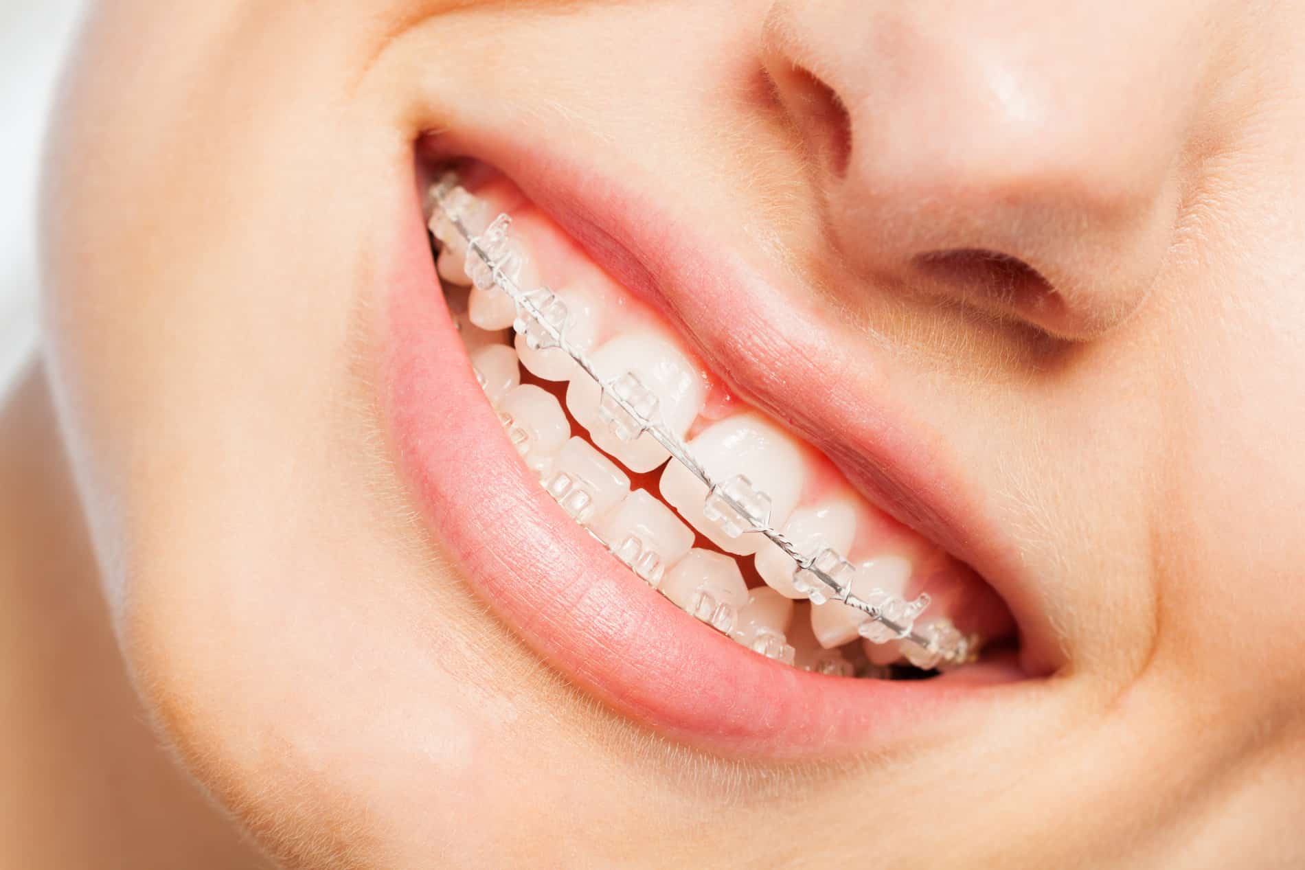Woman with clear ceramic braces in South Jordan UT