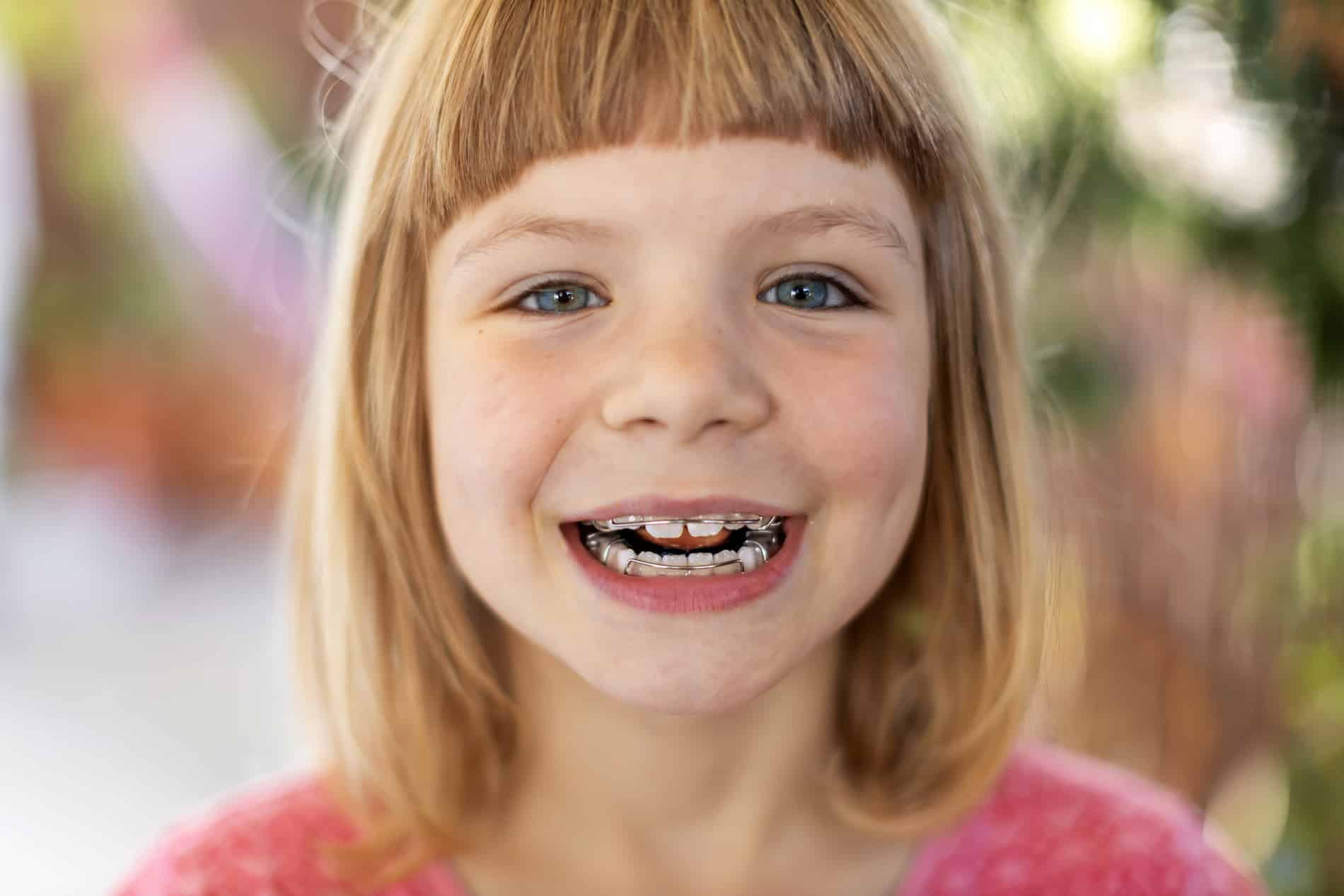 Little girl during her phase 1 orthodontics in South Jordan UT