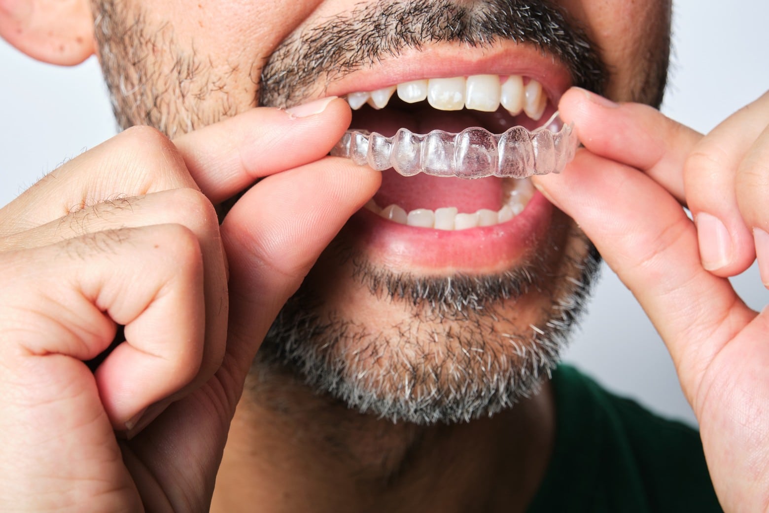 Man putting in his spark clear aligners in South Jordan UT