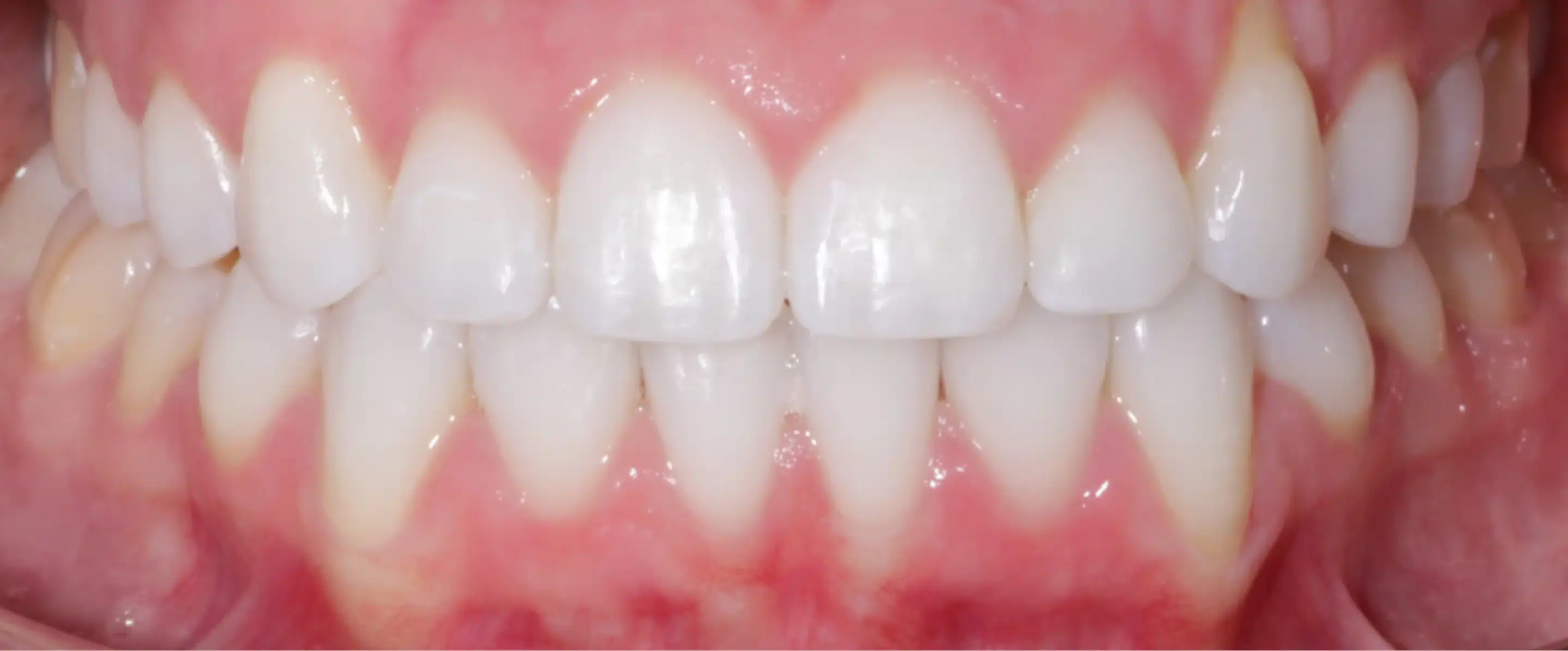 After Orthodontic Treatment Transformation in South Jordan UT