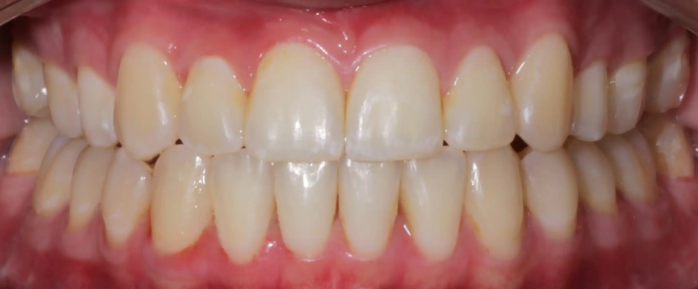 After Orthodontic Treatment Transformation in South Jordan UT