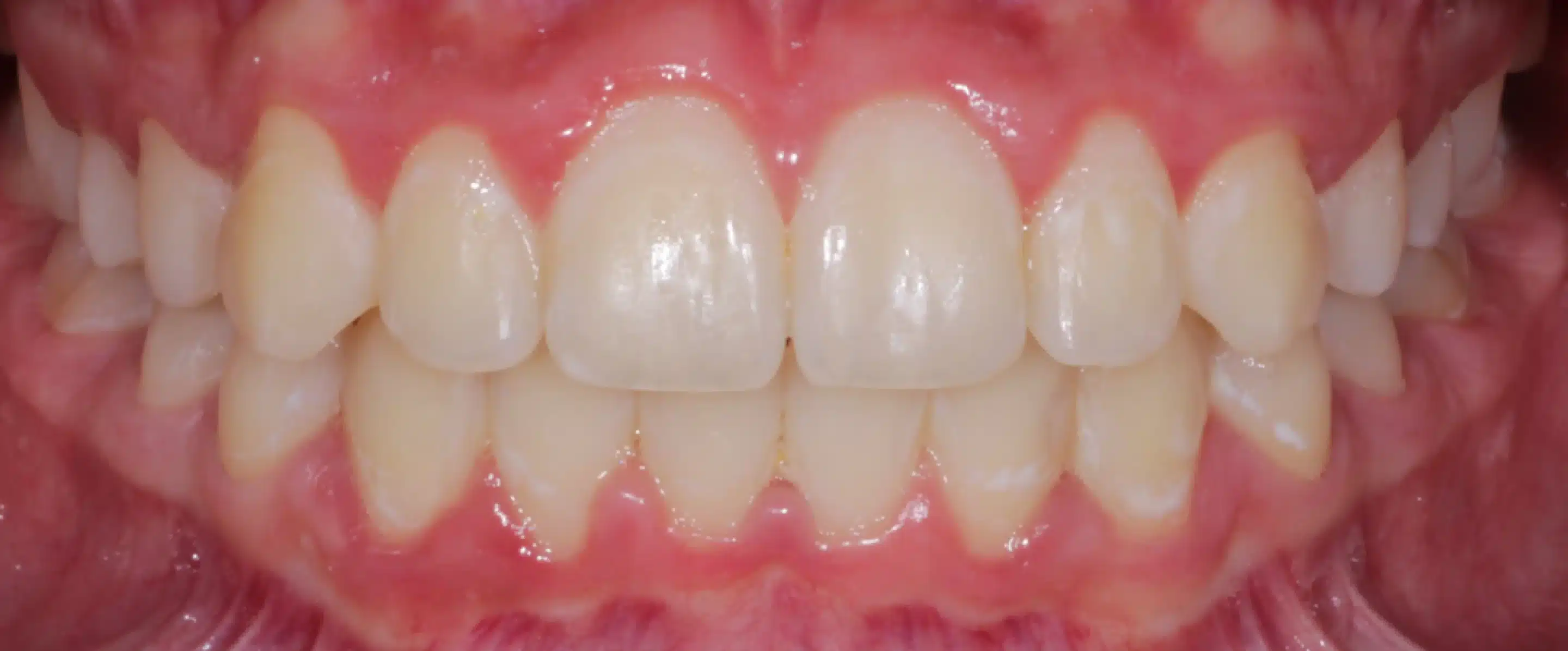 After Orthodontic Treatment Transformation in South Jordan UT