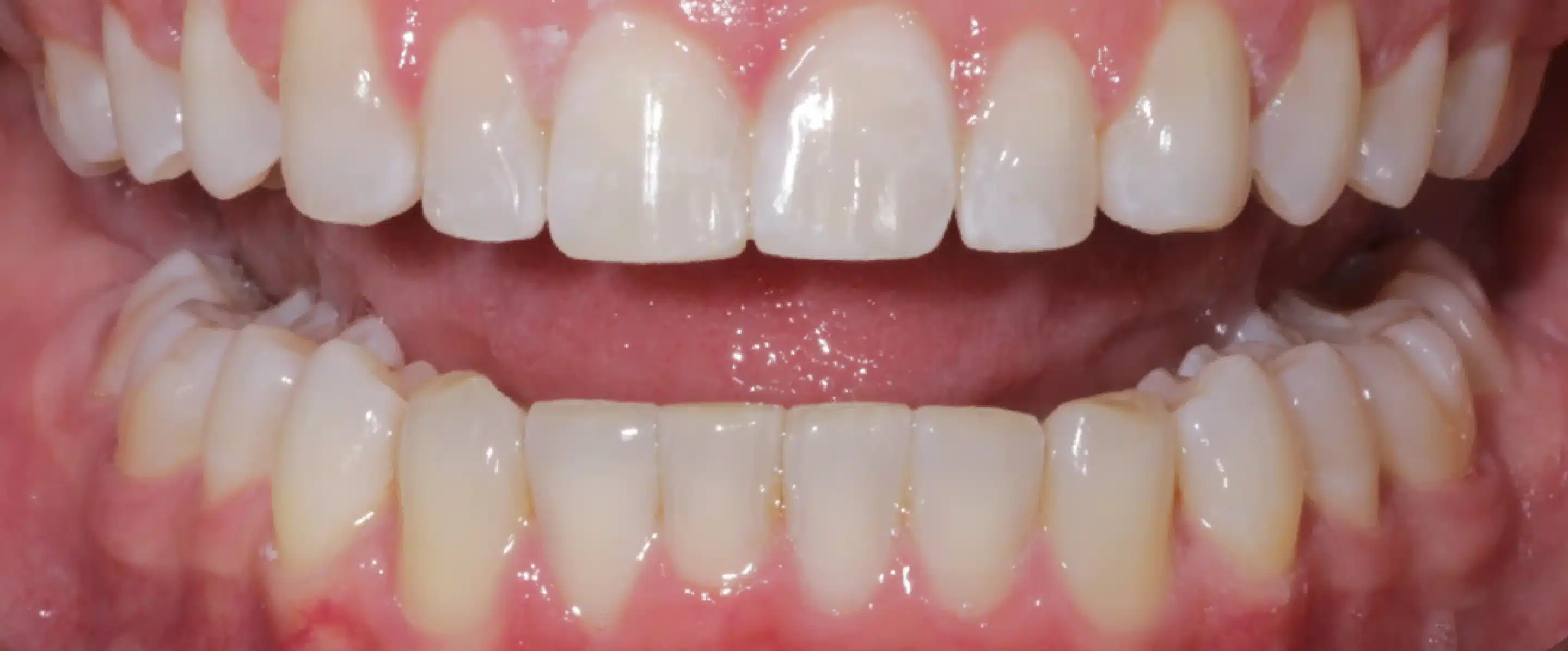 After Orthodontic Treatment Transformation in South Jordan UT