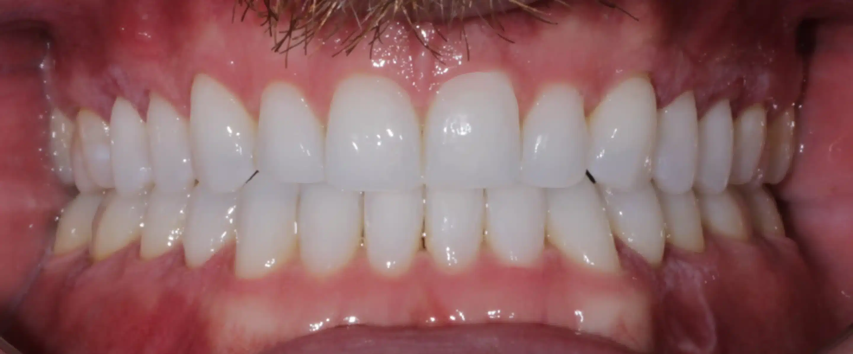 After Orthodontic Treatment Transformation in South Jordan UT