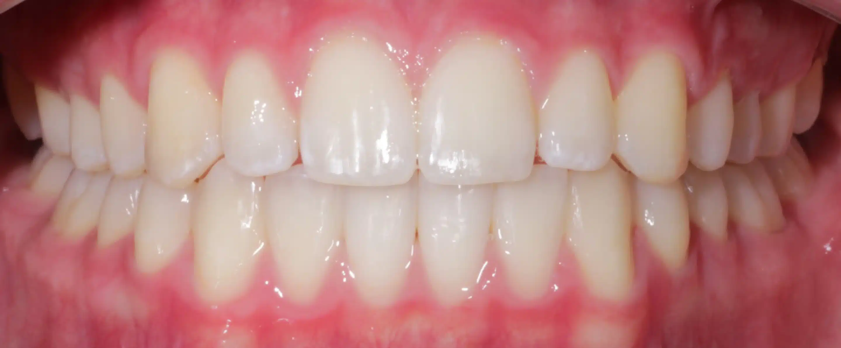 After Orthodontic Treatment Transformation in South Jordan UT