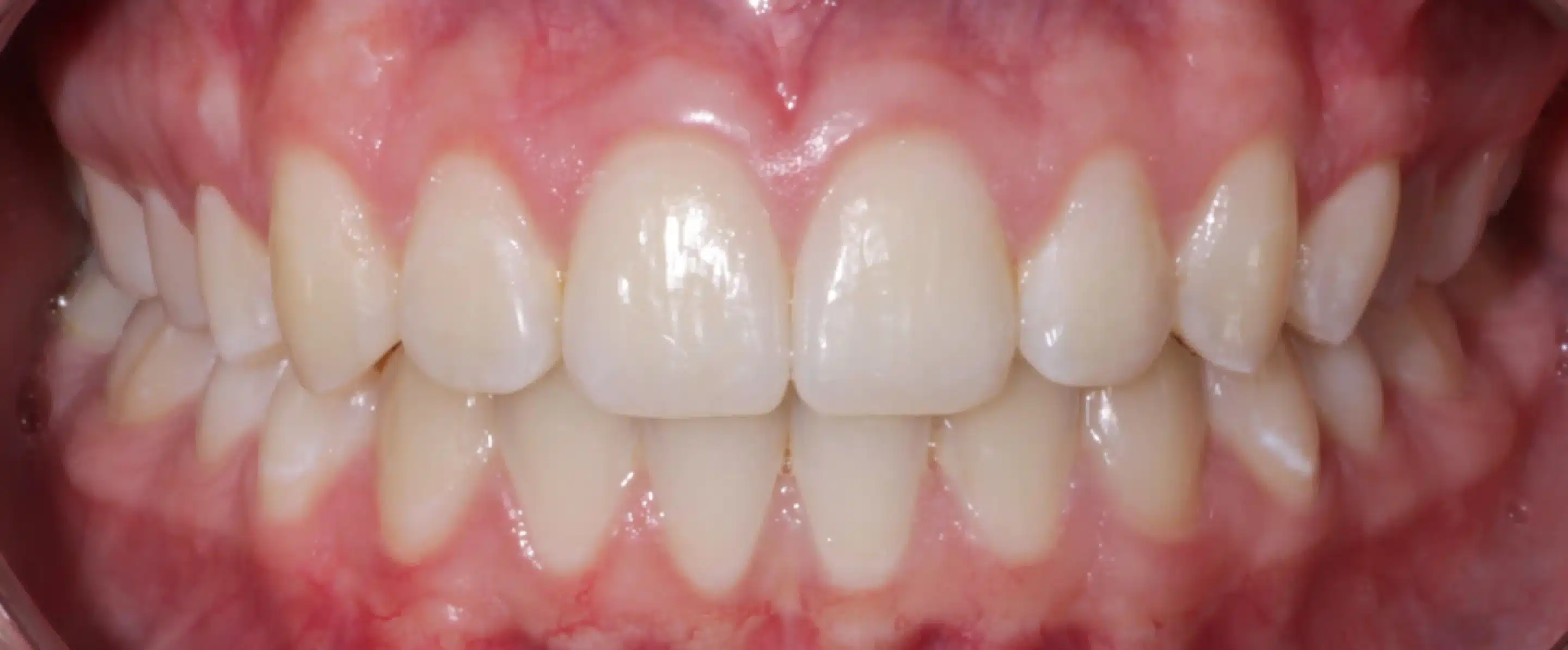 After Orthodontic Treatment Transformation in South Jordan UT