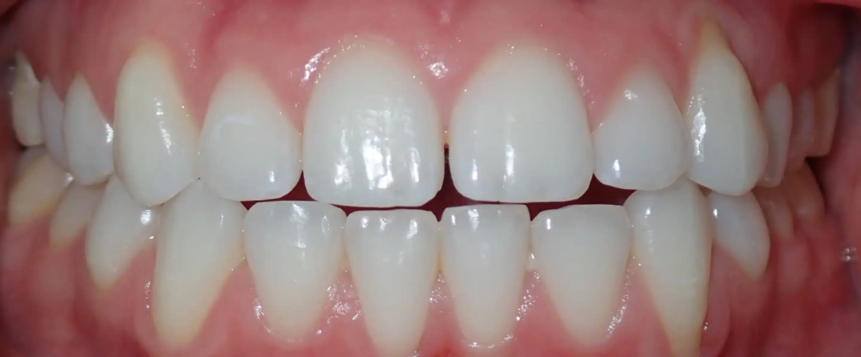 Before Orthodontic Treatment Transformation in South Jordan UT