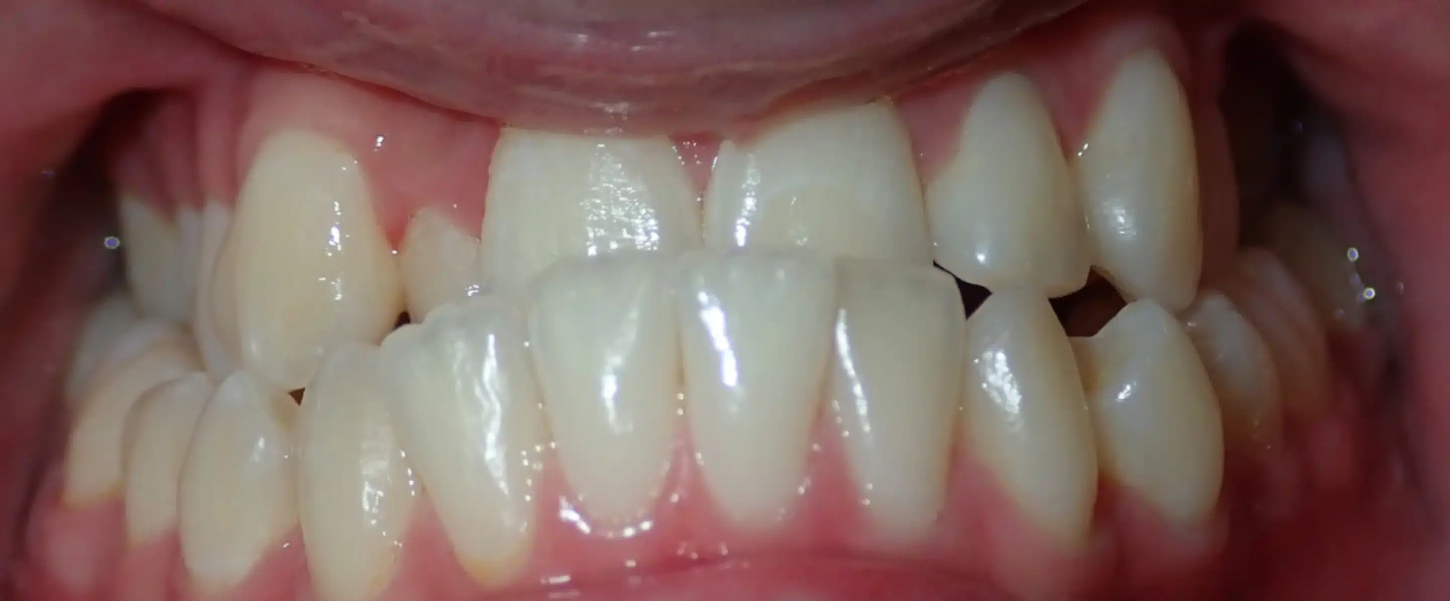 Before Orthodontic Treatment Transformation in South Jordan UT