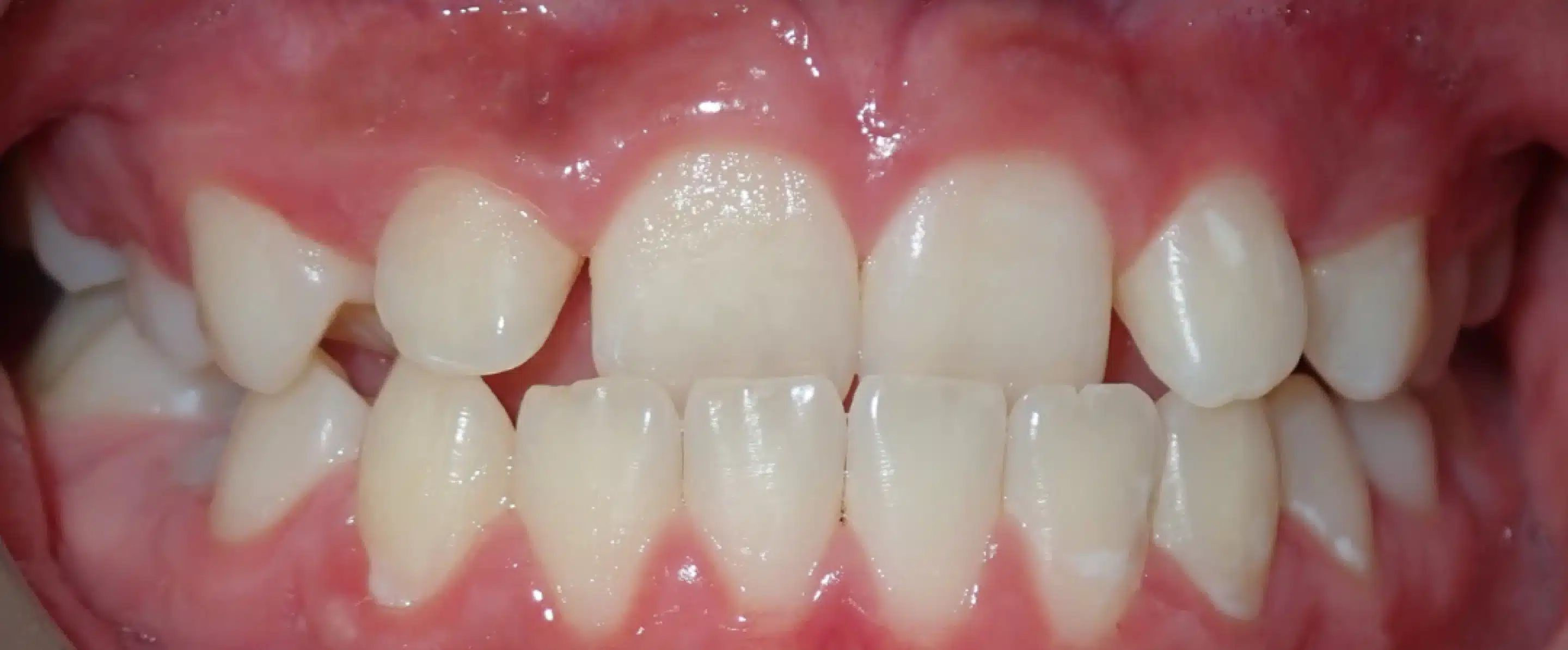 Before Orthodontic Treatment Transformation in South Jordan UT