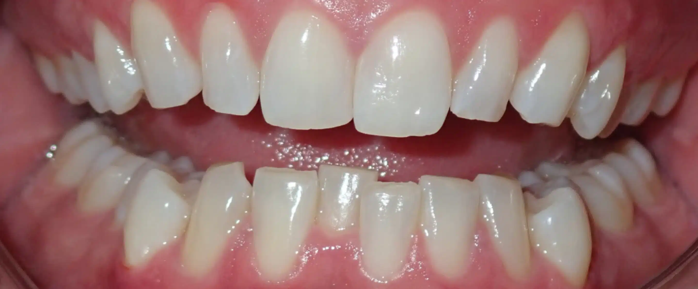 Before Orthodontic Treatment Transformation in South Jordan UT