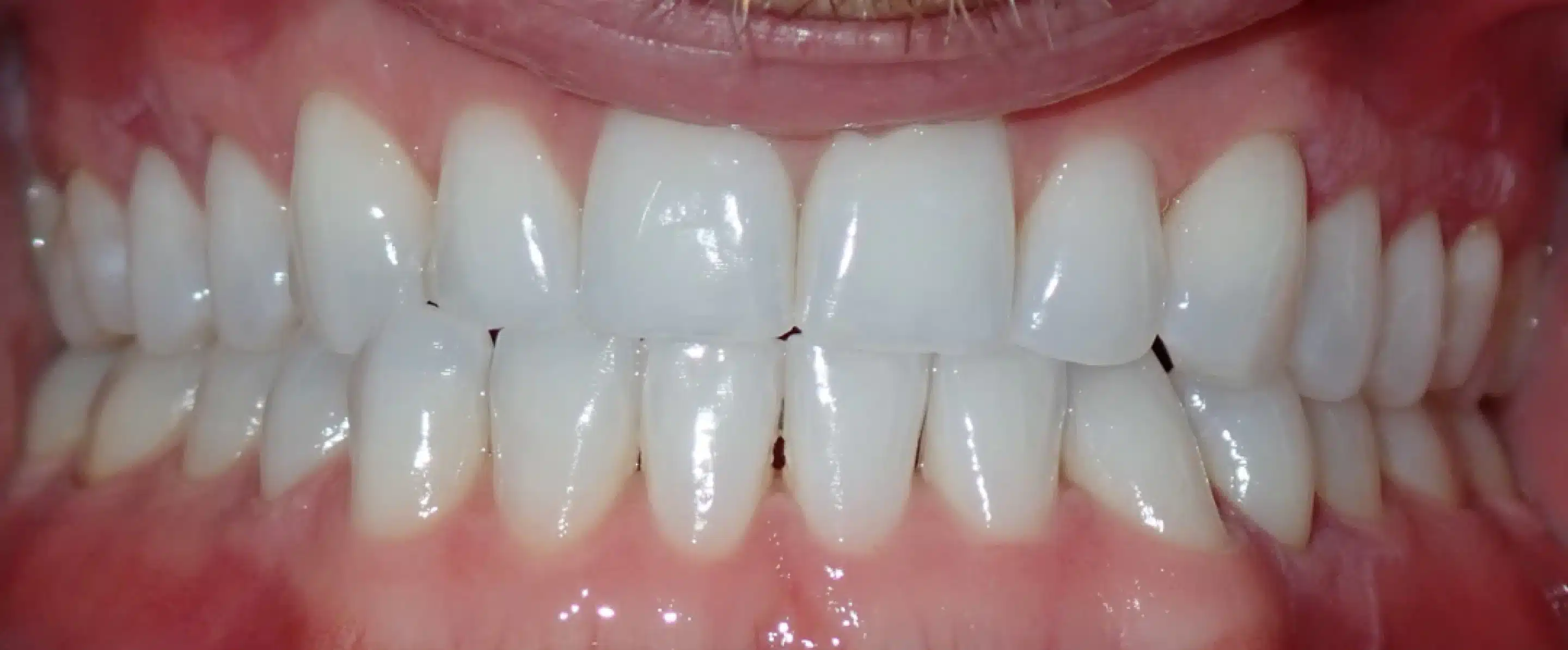 Before Orthodontic Treatment Transformation in South Jordan UT