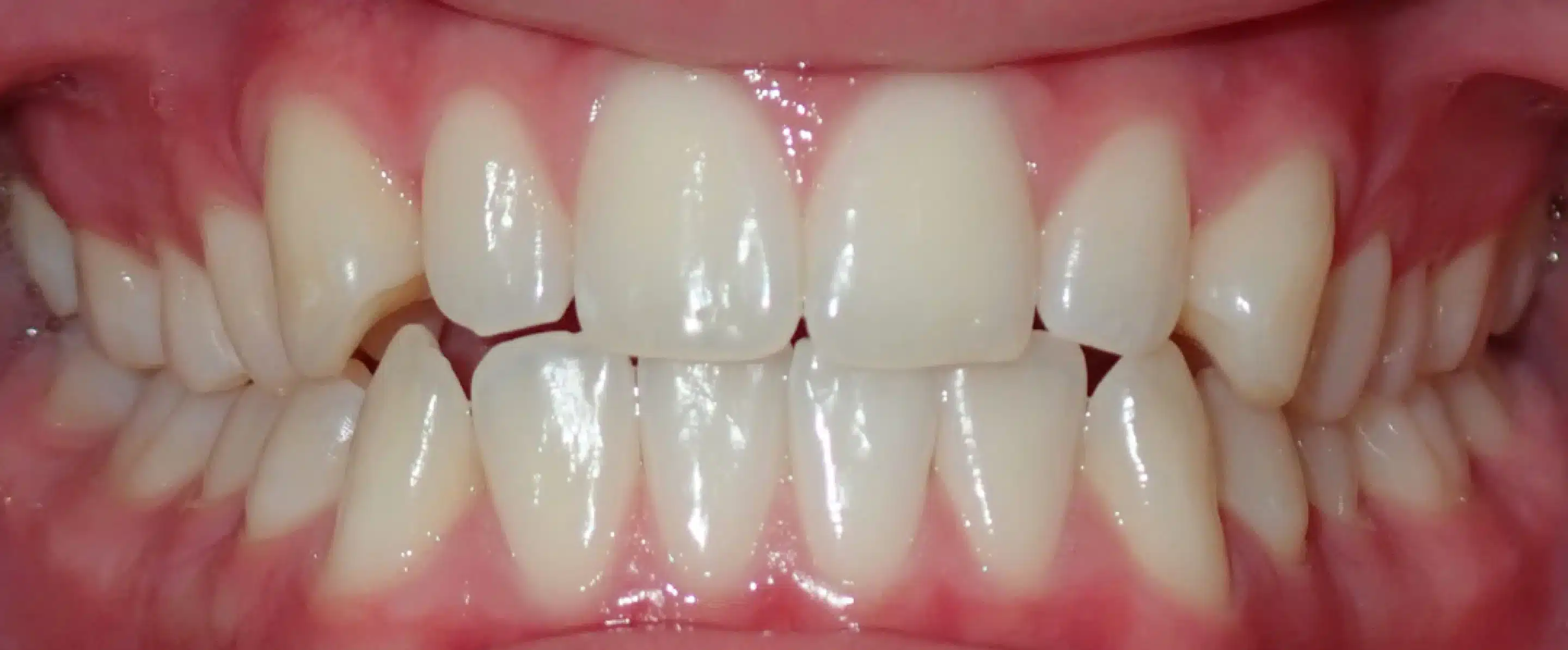 Before Orthodontic Treatment Transformation in South Jordan UT