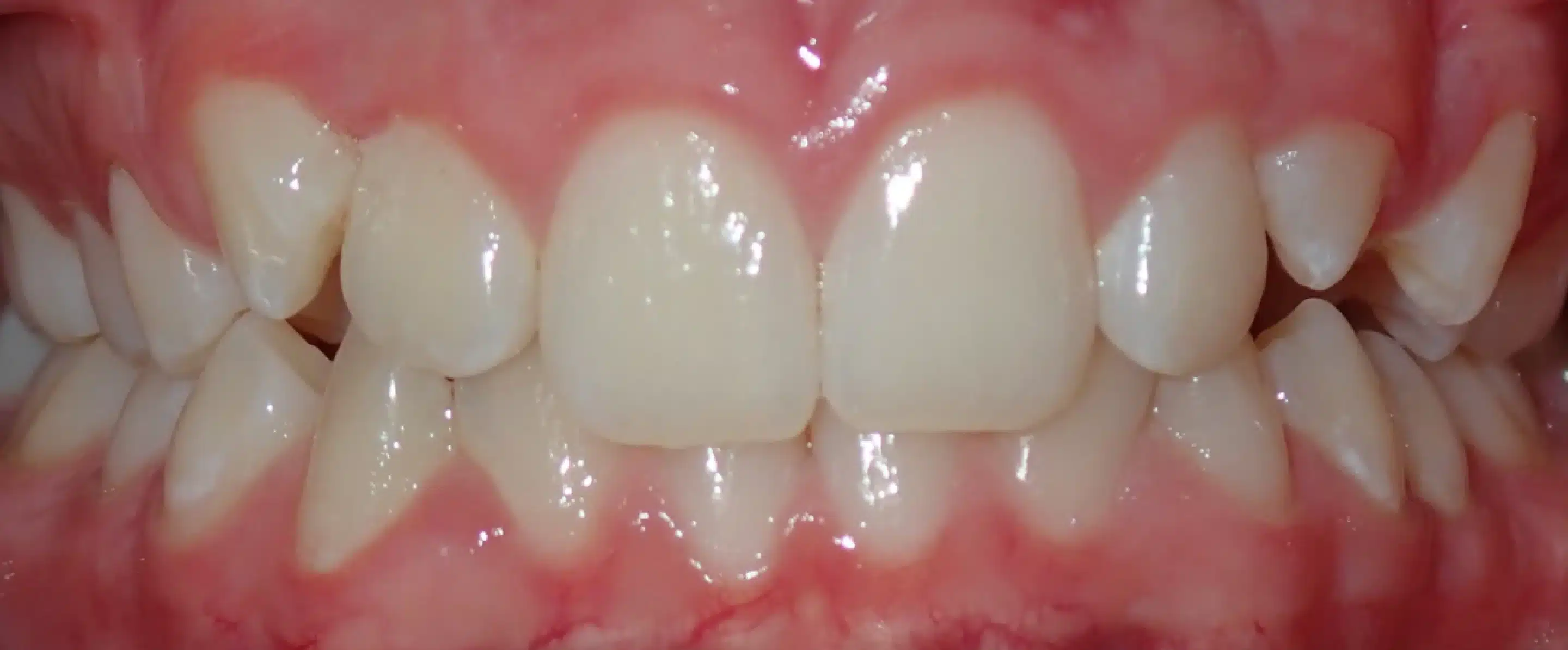 Before Orthodontic Treatment Transformation in South Jordan UT