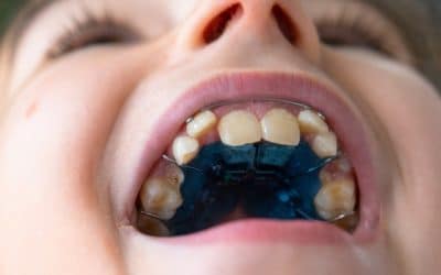 What Is the Best Age for a Child to Get a Palate Expander in South Jordan, UT?