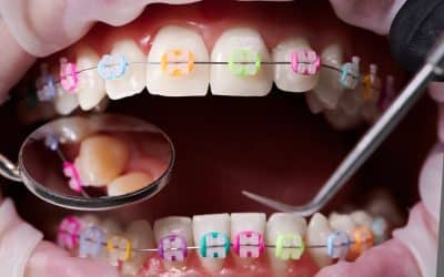 Orthodontic Treatment in South Jordan: What to Know Before You Start