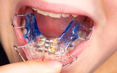 Are Palate Expanders Painful for Kids in South Jordan, UT?